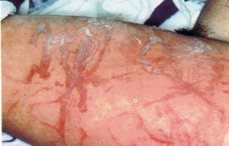 Box jellyfish stings